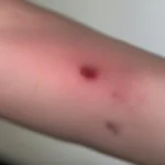 Bed Bug Bites on Arm